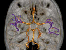 Artere-cerebrale-moyenne-ACM