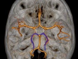 Artere-cerebrale-posterieure-ACP